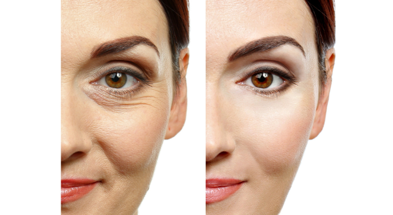 Myths About Fine Lines and Wrinkles Dispelled